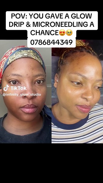Glow Drip and Microneedling Benefits in Midrand & Durban