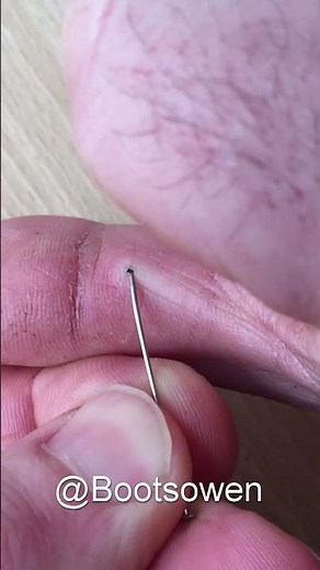 Try this one simple trick to remove a thorn from your finger: Quick and easy for splinter extraction