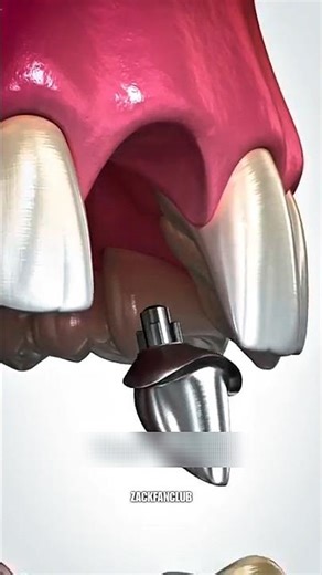 Bone Grafting (Explained)🤔