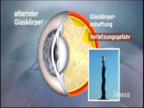 Glaskörpertrübungen im Auge