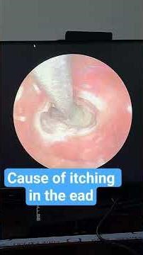 why there is so much itching in your ear. Fungus!!! #ent #earwax #medical #health