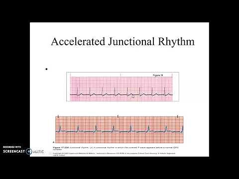 Accelerated Junctional and Junctional Tachycardia