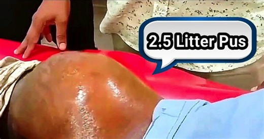 Large Buttock Abscess Pus Drainage