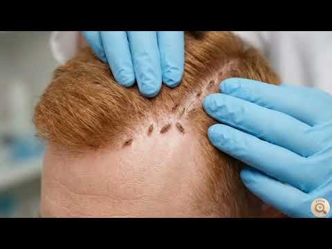 What Do Lice Look Like?