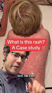 370K views · 3.4K reactions | What is this rash? What is erythema multiforme? #allergies #medication #tiktokdoc #LearnOnTikTok | Zachary Rubin, MD | Facebook