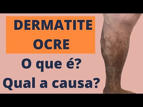 Dermatite Ocre (Manchas na perna): O que é e qual a causa?