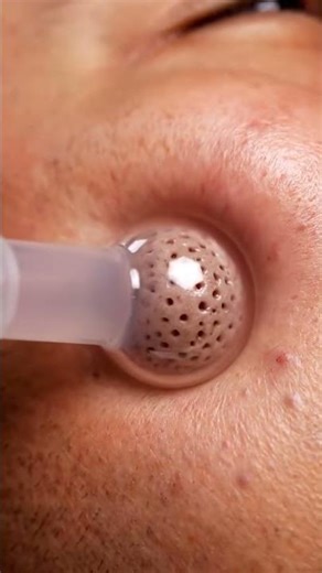 Blackhead Removal for Smooth Skin