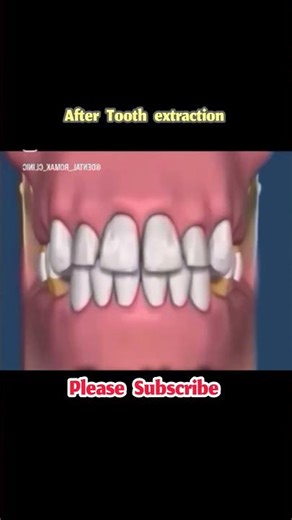 What Happens After Tooth Extraction #dentalcare #oralhealth