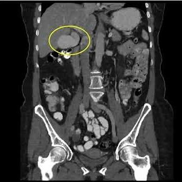 Phrygian (Cap) Gallbladder