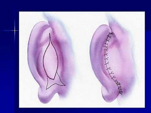 Otoplasty Ear Correction with Dr. Barry Eppley