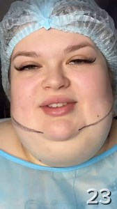This girl had her double chin surgically corrected and changed completely. See how she transformed. | Interesting To Know