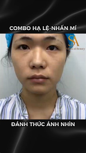 ✨ EYELID LIFT & EYELID SURGERY COMBO RESHAPING A BRIGHT, SOFT, ROUND EYES WITH CHINESE AESTHETIC STANDARDS ✨ Some eyes don't need deep eyelid surgery, just adjusting the height, depth, and opening of the gaze is enough to be captivating. And the EYELID LIFT & EYELID SURGERY combo is the choice of many customers who want big, round, natural-looking eyes without visible intervention. 👁️ WHAT IS THE EYELID LIFT & EYELID SURGERY COMBO? (MEDICAL PERSPECTIVE) This is a combination of two minimally in