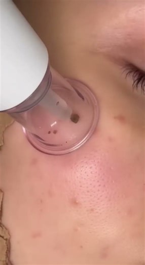 Air Jet ASMR Clean-Up 😳💨✨ |Extreme Face Transformation