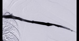 Angioplasty Balloon Angioplasty Percutaneous Transluminal Angioplasty Stock Footage Video (100% Royalty-free) 1101100505 | Shutterstock