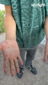 Hands battered & bruised after his dad passes away ✅ Donate now | Spotlight Humanity