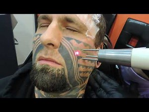 Full Face Removal Session One Part Two