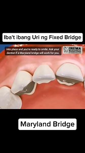 216K views · 730 reactions | Different Types of Fixed Bridge #irumadentalclinic #trendingreels #oralhealth #question #tips #dentist #dentalclinic #OralCare #questionoftheday #fixedbridge #mostaskedquestions #oralhygiene #dental #dentalcare #DentalHealth | Iruma Dental Clinic | Facebook