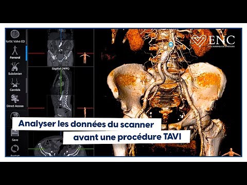 Comment analyser un scanner avant TAVI ?