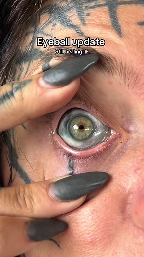 Eyeball Tattoo Healing Process Update
