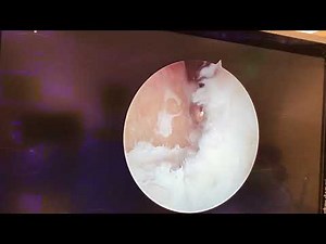 Ankle Arthroscopic Surgery Video (featuring the ConMed "Gator" Shaver)