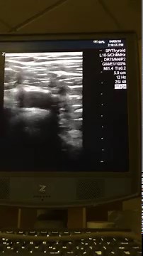 PulmCrit- Shrug Technique for US-guided subclavian lines