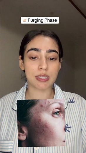 Three stages of Closed Comedones.