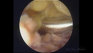 External Snapping Hip