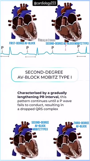 🔹 Classification of AV Blocks🫀