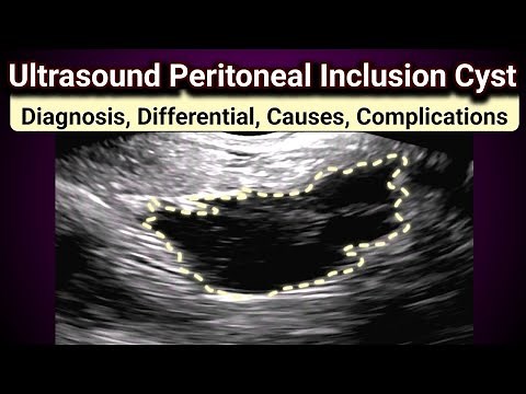 Ultrasound Peritoneal Inclusion Cyst | Post Surgical Complications