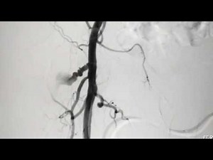 Groin Pseudo Aneurysm Treatment
