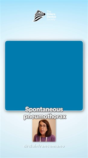 43K views · 632 reactions | Vascular Ehlers-Danlos syndrome (vEDS) is...