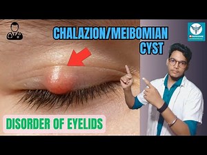 chalazion or meibomian cyst | Etiology, Stages & Management | eyelid disorders | By Manjeet