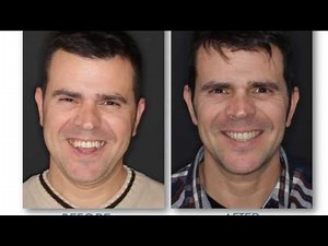 OPEN BITE RESOLVED WITH ORTHOGNATHIC SURGERY | MAXILLOFACIAL | BEFORE AND AFTER