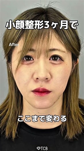 【脂肪吸引】ここまで変わる！#shorts