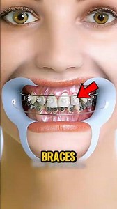 What Braces REALLY Do to Your Teeth It’s Not What You Think!