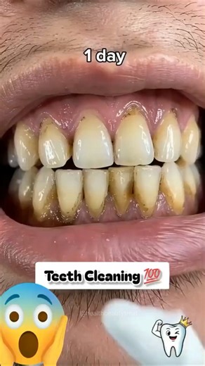 Yellow Teeth To White Naturally At Home | Instant Teeth Whitening, Teeth Cleaning Tips #teethcare