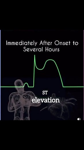 Muneer Jan on Instagram: "ECG Evolution in Myocardial Infarction (MI) – Evidence-Based Timeline The ECG changes in MI evolve over time. Recognizing the sequence helps in diagnosis and staging the infarct: ⸻ ✅ 0–12 Hours (Acute Phase) ST-Segment Elevation • Indicates acute transmural injury. • Seen in ≥2 contiguous leads. • Often accompanied by hyperacute T waves early. ⸻ ✅ 12 Hours – 1 Week (Evolving Phase) Pathological Q Waves develop • Depth >25% of R wave or duration ≥0.04 sec. • Sign of irre