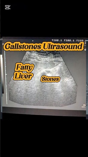 Cholelithiasis Ultrasound | Fatty Liver | Gallstones | Gallbladder Stones