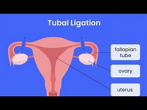Tubal Ligation birth control ; surgically cutting, tying, or sealing the fallopian tubes