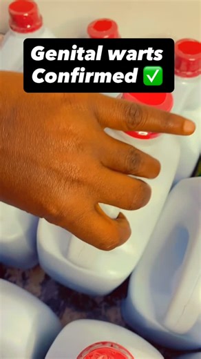 ARIYIKE ALAGBO||CERTIFIED HERBAL BRAND IN LAGOS on Instagram: "Genital warts are a type of sexually transmitted infection (STI) that causes warts (small bumps or growths) to form in and around your genitals and rectum. Certain strains of human papillomavirus (HPV) cause genital warts……. Genital warts spread through: Intercourse: including anal, vaginal-penile and vaginal-vaginal. Genital touching (skin-to-skin contact without ejaculation). Giving oral sex to someone who has HPV or genital warts.