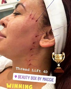 A new range Barb 4D threads for skin lifting and revitalization has just been released onto the market !!✨£599 Face or £699 Face & Neck 👉🏼 The treatment with the latest threads is an incredibly easy and safe method of regeneration, which was invented for those clients who expect swift and specular effects.First Lift Barb 4D thread with hooks extended in four directions has become number one on the market! Our offer comprises the three following PDO threads for lifting: First Lift PDO - a thin 