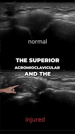 Type II AC Joint Instability: The hidden horizontal instability