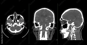 A CT scan of the brain shows a subarachnoid hemorrhage scattered at both frontal lobes, temporal lobes, basal cistern and prepontine cistern., highlighting areas of bleeding.
