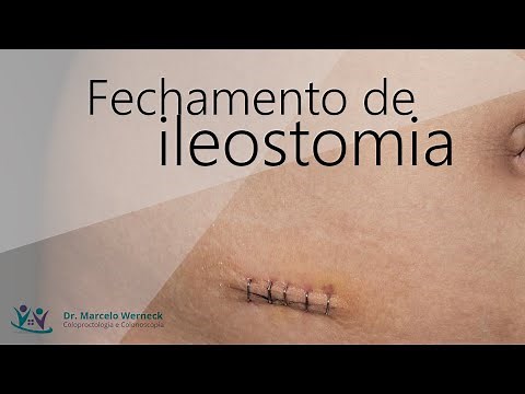 What is the postoperative period like after ileostomy closure?