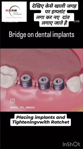 Placing new teeth with dental implants #dentalimplants #newteeth