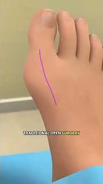 Do You Have This Bump? 🇱🇷 (Bunion Surgery Explained) 🦶