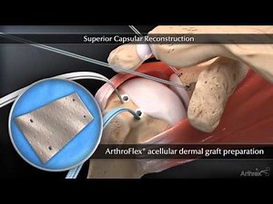 Arthrex Superior Capsular Reconstruction