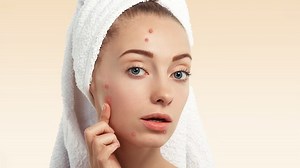 Dermatologist Decodes Forehead Acne Causes and Treatment Options