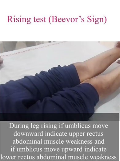 Rising test (Beevors sign)