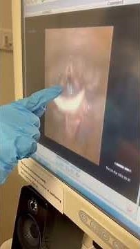 FEES demonstration | Fibreoptic Endoscopic Evaluation of Swallowing